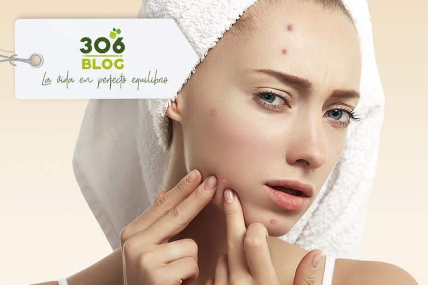 ¿Tienes piel con acné?: Cómo limpiar y cuidar en 7 pasos